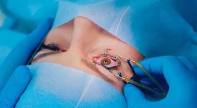 LASIK Surgery in Bangalore, Best LASIK Surgeon