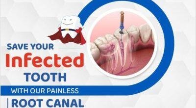 Best clinic for root canal treatment near me?