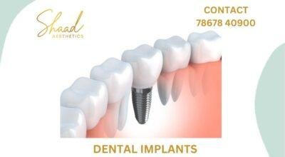 Tooth implants in coimbatore | shaadaesthetics