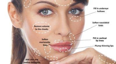 Renovate Your Natural Beauty at the Best Dermal Fi