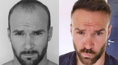 Get Top Hair Transplant Clinics in Delhi