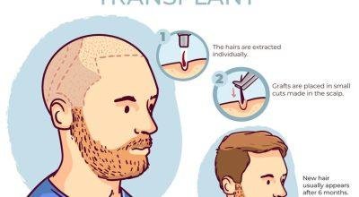 Get Natural Look with the Best Hair Transplant