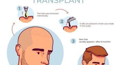 Best Hair Transplant Clinic in Delhi: Myo Clinix