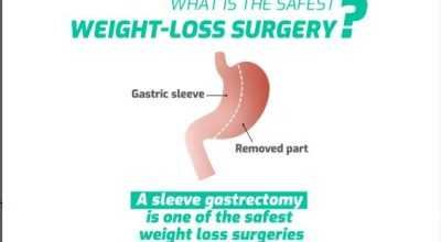 Best Weight Loss Surgery | Ugale Bariatrics