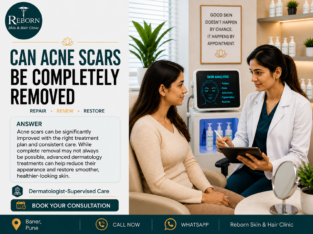 Acne Scar Treatment in balewadi