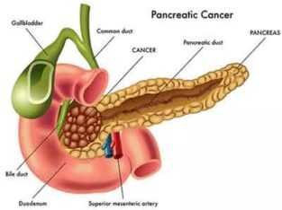 Trusted Pancreatic Cancer in Noida |cancerconsult