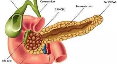 Trusted Pancreatic Cancer in Noida |cancerconsult