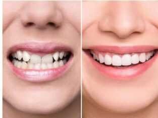 Cosmetic Dental clinic in bangalore