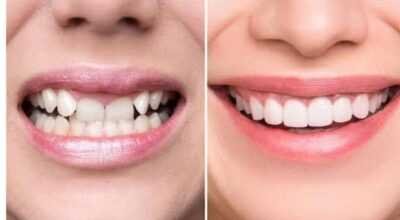 Cosmetic Dental clinic in bangalore