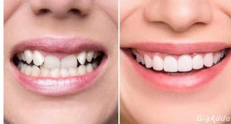 Cosmetic Dental clinic in bangalore