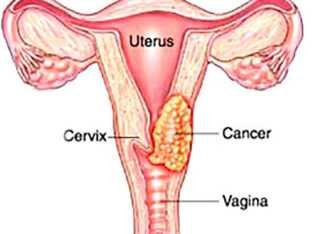 Cervical Cancer Doctor in Noida – cancer consult