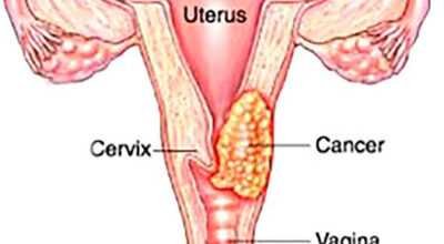 Cervical Cancer Doctor in Noida – cancer consult