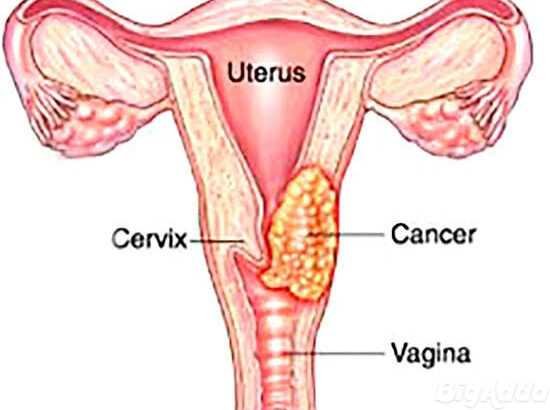 Cervical Cancer Doctor in Noida – cancer consult