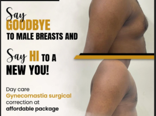 Gynecomastia Surgery in Chennai | Aesthetic Studio