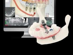 Dental Implant Cost in India