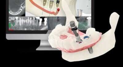 Dental Implant Cost in India