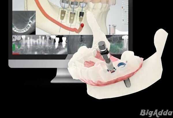 Dental Implant Cost in India