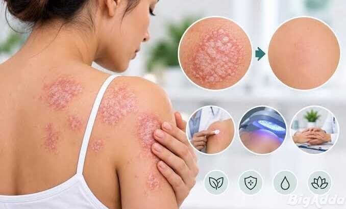 Psoriasis Treatment in Roorkee