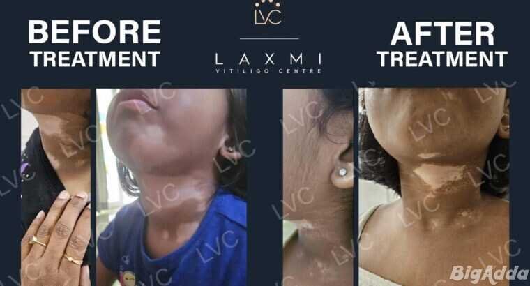 Homeopathic Vitiligo Treatment in Madurai | Laxmi