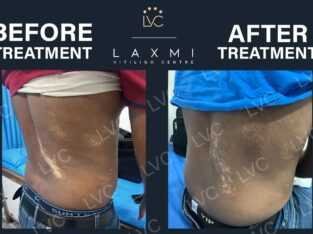 Homeopathic Vitiligo Treatment in Madurai | Laxmi