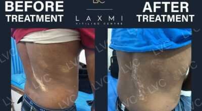 Homeopathic Vitiligo Treatment in Madurai | Laxmi