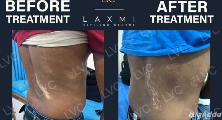Homeopathic Vitiligo Treatment in Madurai | Laxmi
